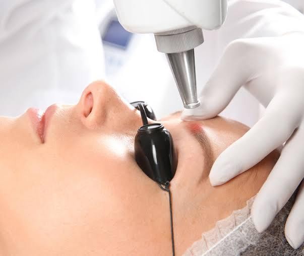 Remoção de micropigmentação a laser
